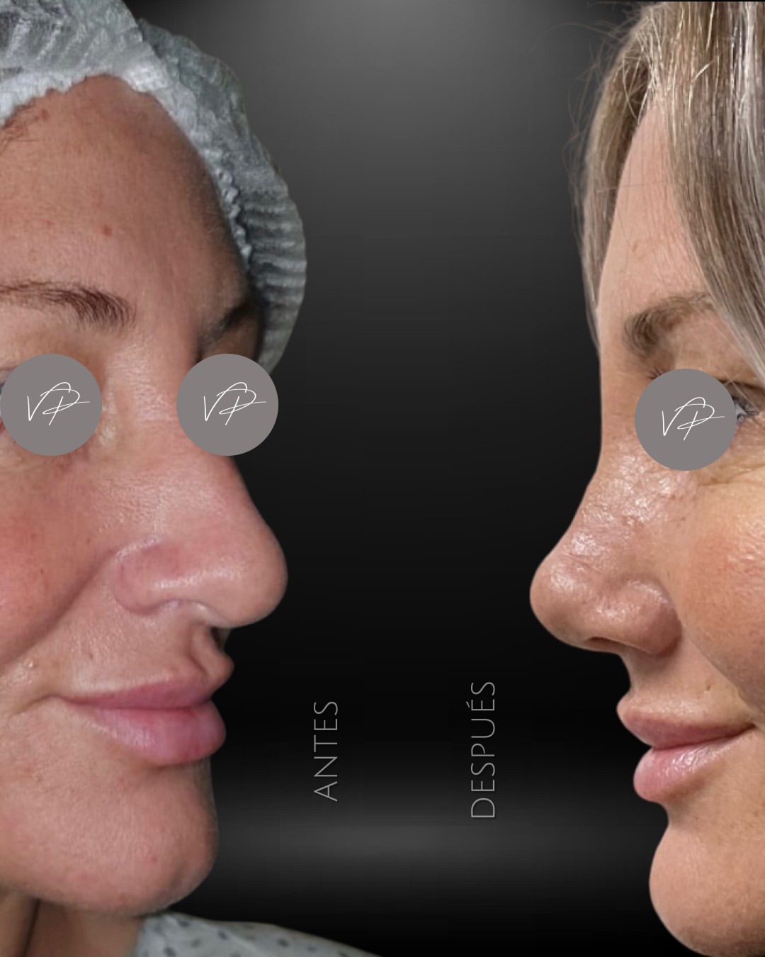 Rinoplastia antes y después